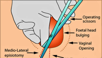 episiotomy