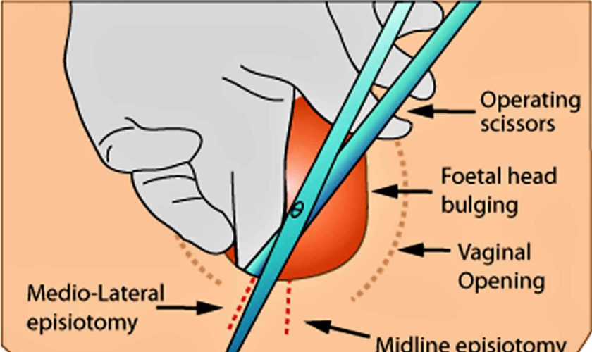 episiotomy