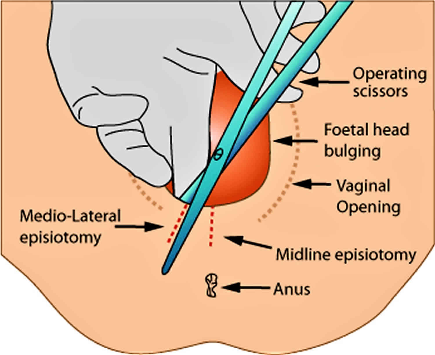 Episiotomy Episiotomy Vs Tear Episiotomy Care Complications