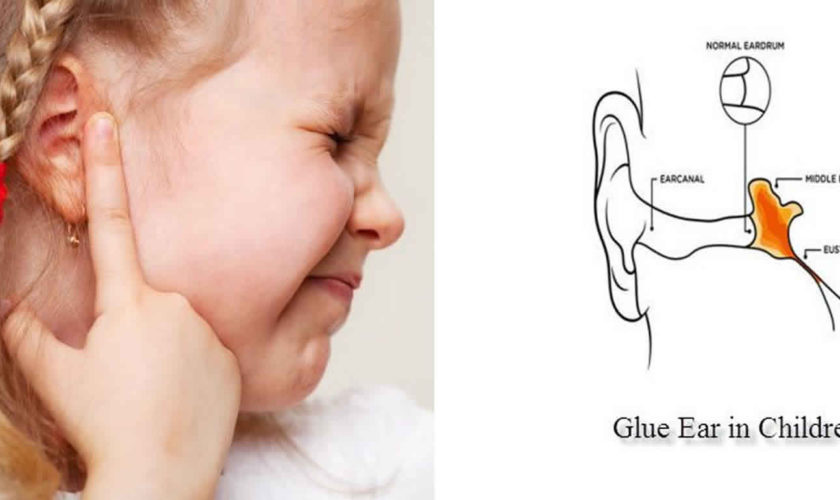 glue ear