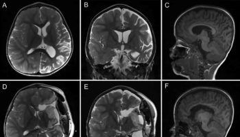 hemispherectomy