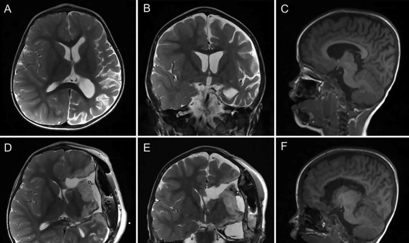 hemispherectomy