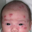 pediatric lupus