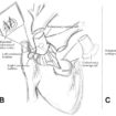 ross konno procedure