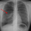 spontaneous pneumothorax