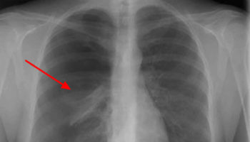 spontaneous pneumothorax