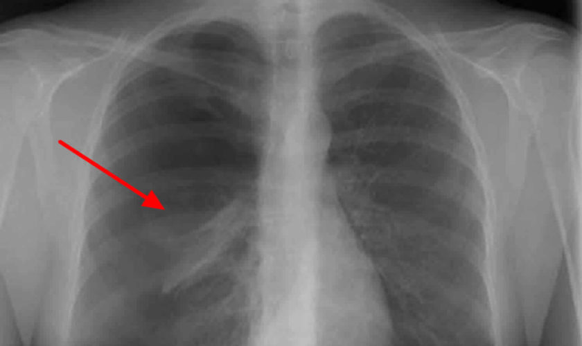 spontaneous pneumothorax