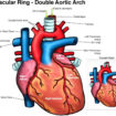 vascular ring