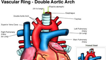 vascular ring