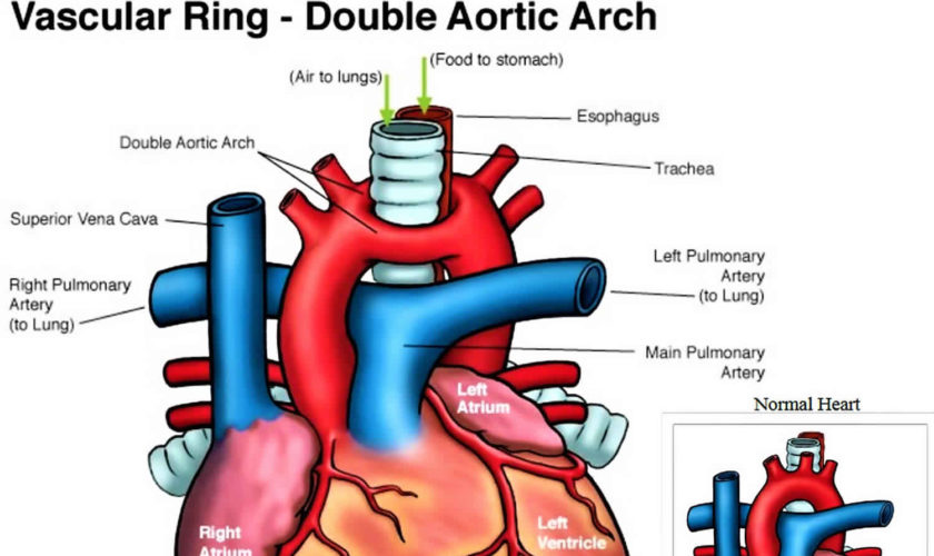 vascular ring