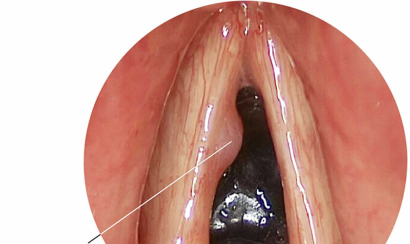 vocal cord cyst