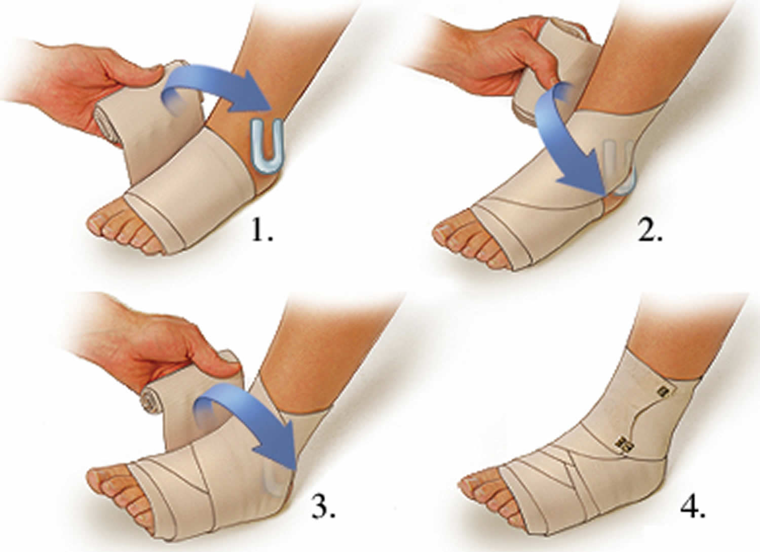 How to wrap a sprained ankle