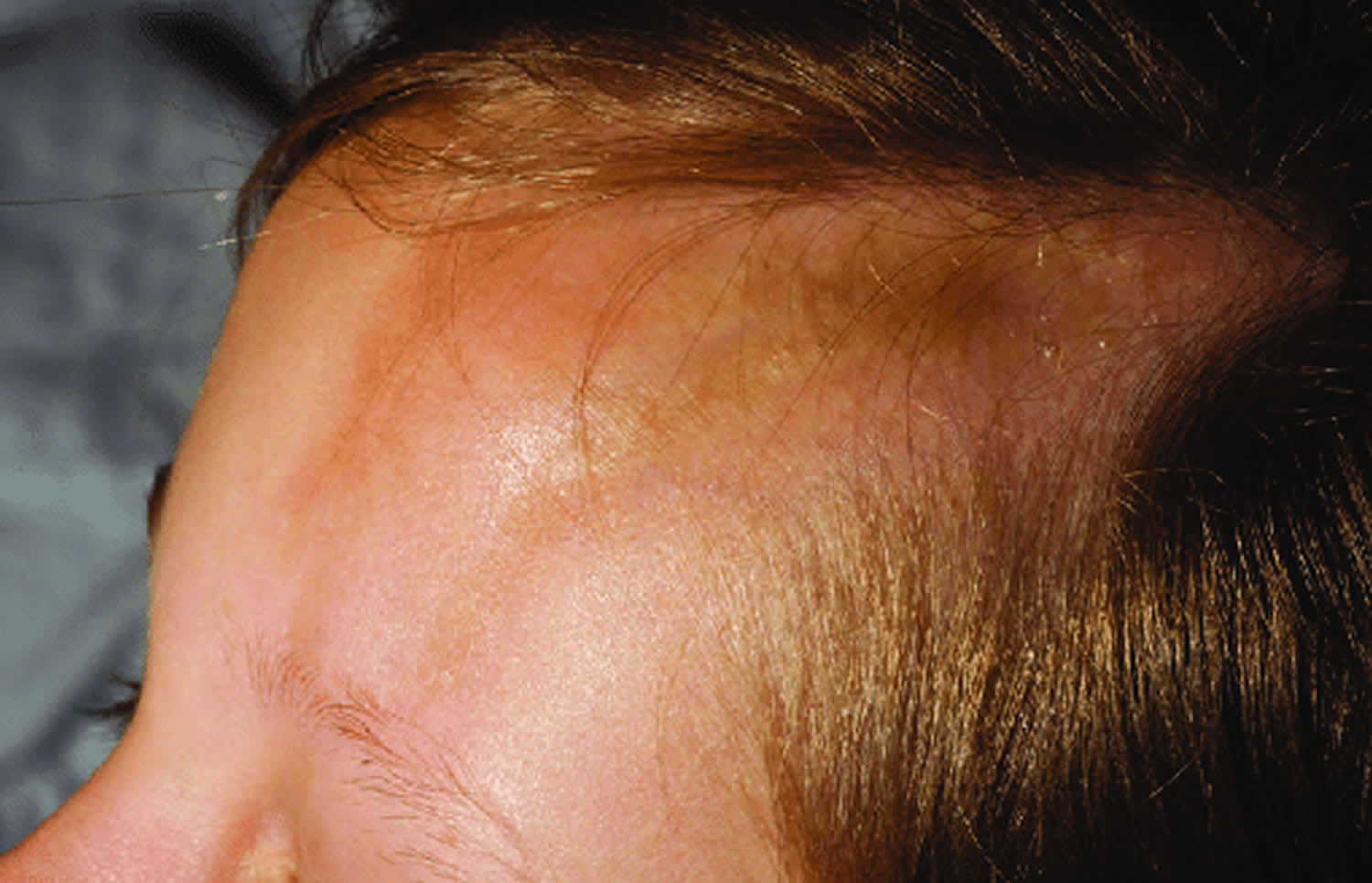 linear scleroderma forehead