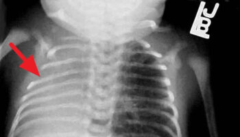 pulmonary hypoplasia
