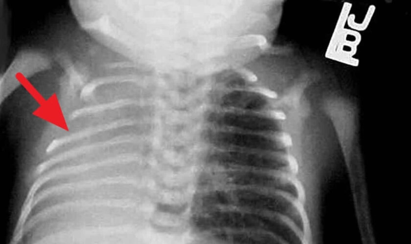 pulmonary hypoplasia